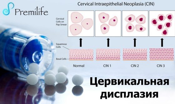 cervical-dysplasia-russian